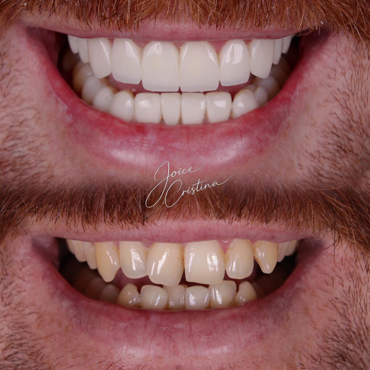 Transformação de sorriso - antes e depois