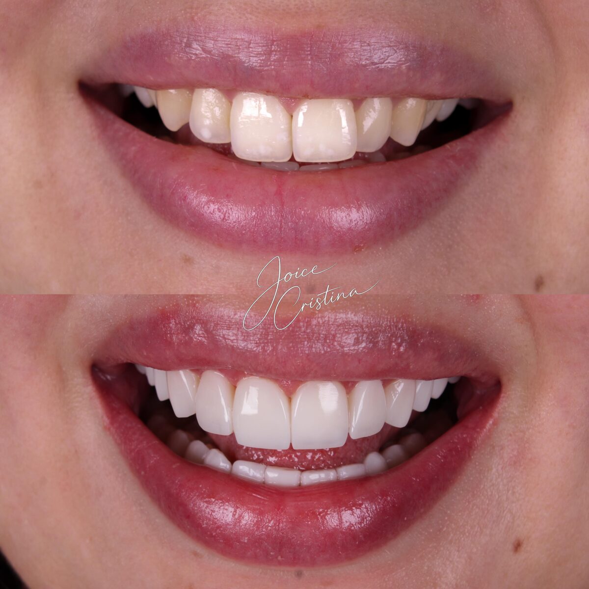 Facetas em resina - antes e depois