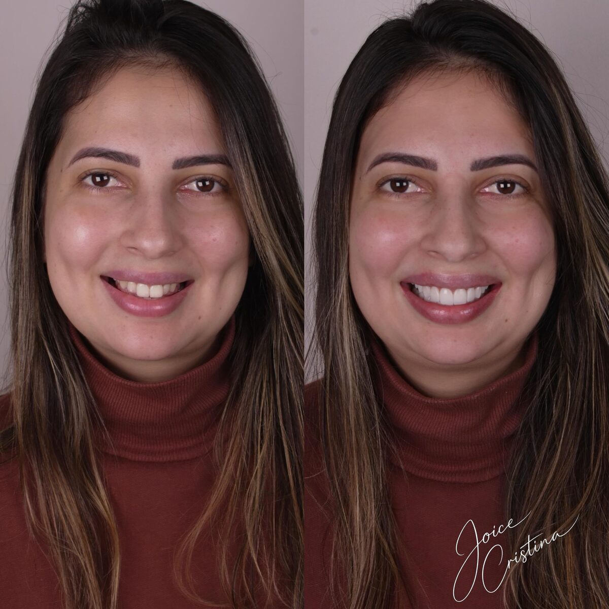 Facetas em resina detalhe