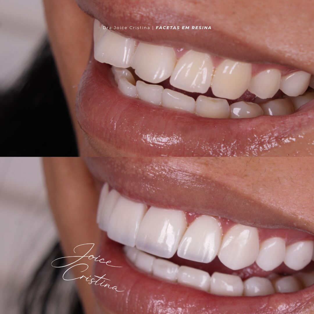 Reabilitação dentária