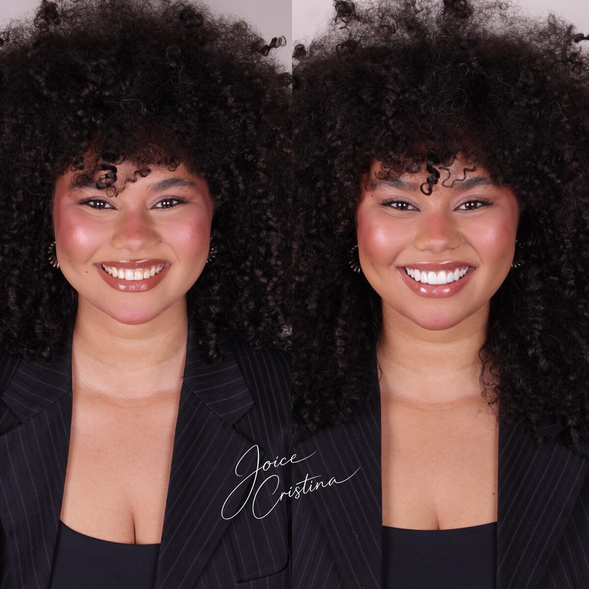 Lentes de resina - antes e depois